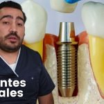 ¿Cuánto cuesta un implante mandibular? 4